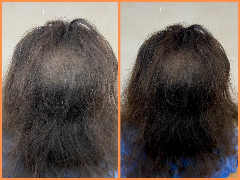 tricopigmentazione uomo 2